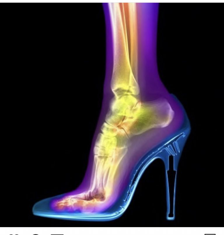 No Pain, No Gain: High Heels Can Lead To A Dozen Foot And Leg Injuries